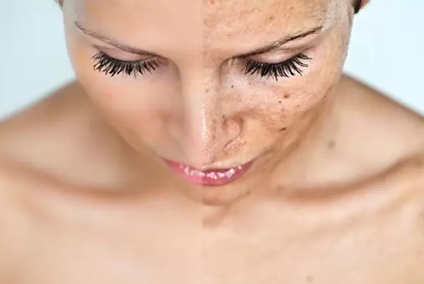 Melasma: por que o tratamento personalizado com ativos manipulados ganha força no outono