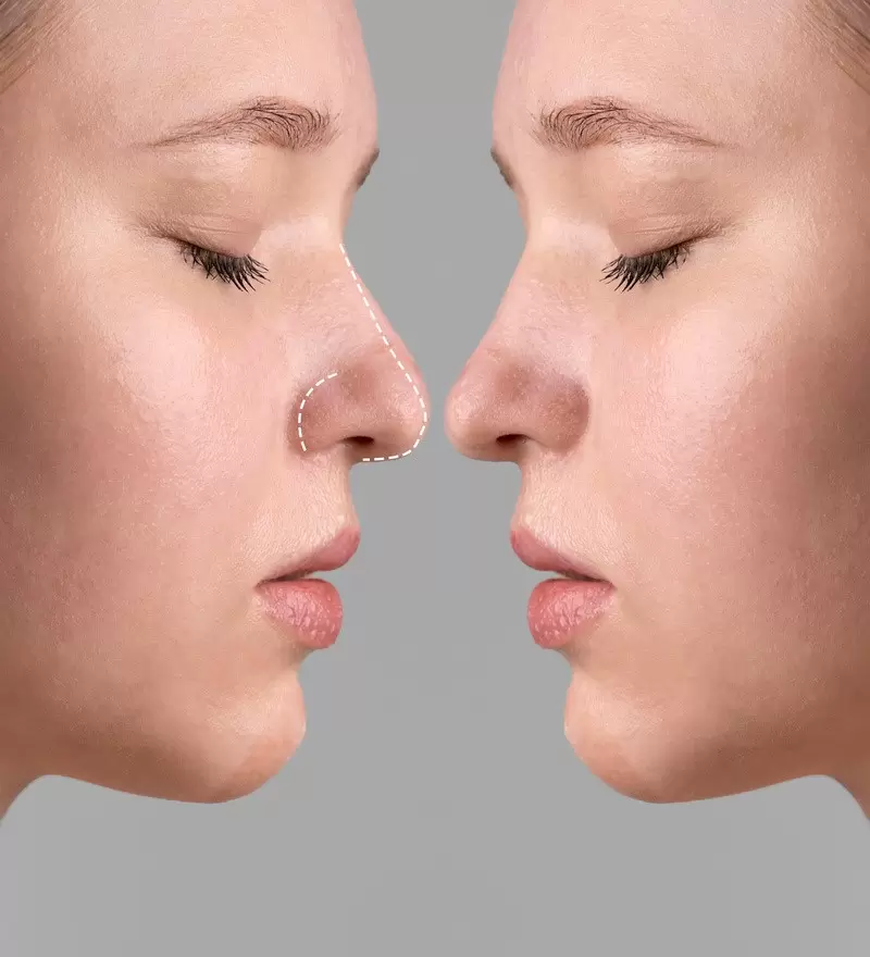 Rinoplastia: estética ou saúde? Entenda quando a cirurgia do nariz é necessária